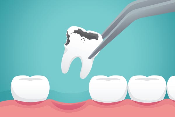 Ask a General Dentist: What Happens to Your Tooth After Extraction from Vital Dental of Bayside in Bayside, NY