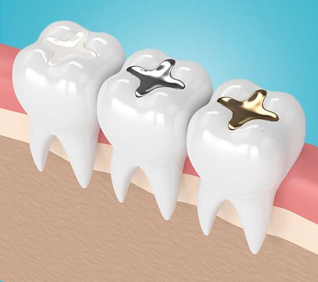 Bayside Composite Fillings