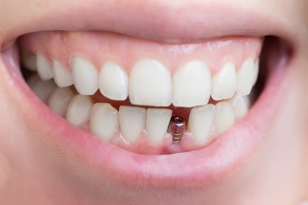 Dental Implant Restoration Bayside, NY
