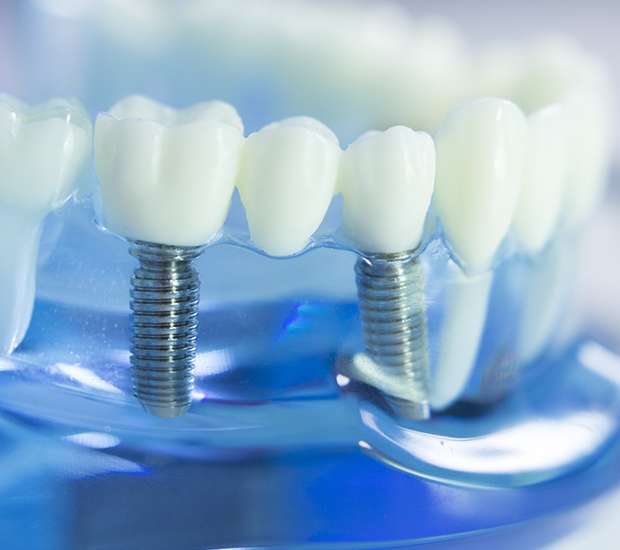 Bayside Dental Implants